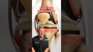 Knee Replacement FAIL Options #shorts