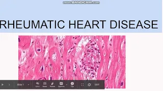 Rheumatic Heart Disease: Pathogenesis, Morphology, Clinical features