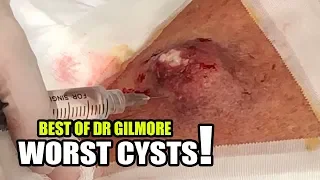 Speedy Back Cyst:  Dr. Gilmore's Worst Extractions