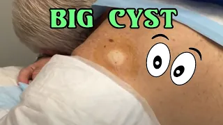 Back of the Shoulder Cyst Excision