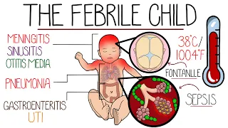 Approach to Fever in Children in 10 Minutes (with Red Flags)