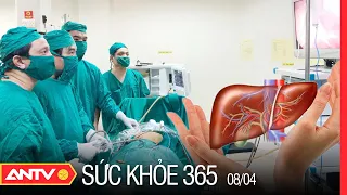 Các Phương Pháp Điều Trị Ung Thư Gan Hiệu Quả | Sức Khỏe 365 | ANTV