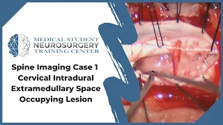 Spine Imaging Case1: Cervical Intradural Extramedullary Space Occupying Lesion