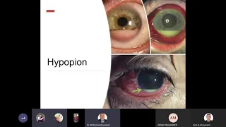 Lecture 6  Uveitis