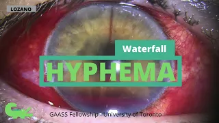 Stopping a Hyphema at the Slit Lamp