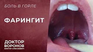 Фарингит. Боль в горле. Что делать? Какие симптомы?