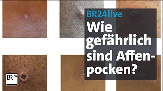 BR24live: Erster Fall in Bayern - wie gefährlich sind die Affenpocken?