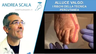 ALLUCE VALGO: Tecnica Percutanea | Alluce valgo prima e dopo | Dott. Andrea Scala