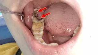 Tooth extraction molar