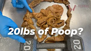 How Much Poop Is Stored in Your Colon??