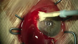 Eye injury repair (globe rupture) from stick injury