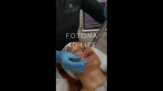 Fotona 4D Lift