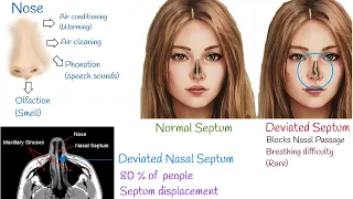 Deviated septum- symptoms, treatments and causes. Nasal Septal deviation