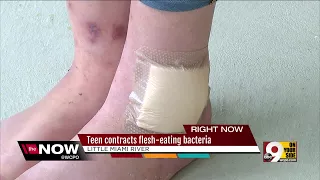 Warren County teen nearly loses foot to flesh-eating bacteria after canoe trip on Little Miami River