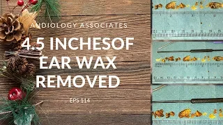 4.5 INCHES OF EAR WAX REMOVED - EP 114