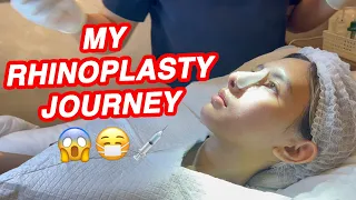 RHINOPLASTY JOURNEY