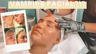Vampire Facial?? My before and After Results!