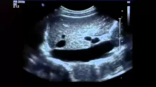 Ultrasound Training Liver