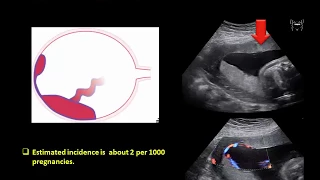 Ultrasound Imaging of the placenta: Part 1 Anatomy and Variants.