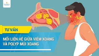 Mối liên hệ giữa viêm xoang và polyp mũi xoang