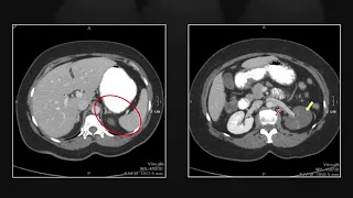 Renal Vascular Emergencies  | Interesting Radiology Cases