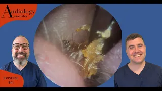 EAR WAX REMOVALS USING CROCODILE FORCEPS, JOBSON HORNE & MICROSUCTION - EP841