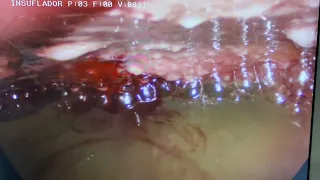 Carcinomatose Peritoneal - Videolaparoscopia