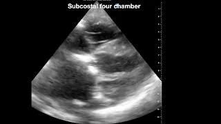 Subcostal four chamber