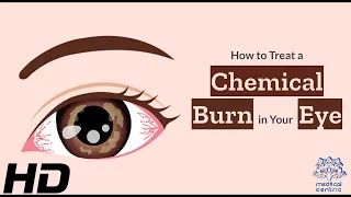 Eye Emergency: How to Properly Manage a Chemical Burn in Your Eye