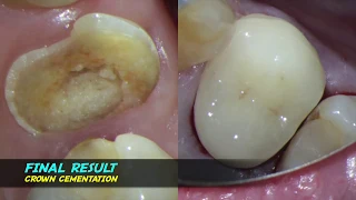 single visit root canal therapy endodontic one curve micro-mega warm vertical compaction