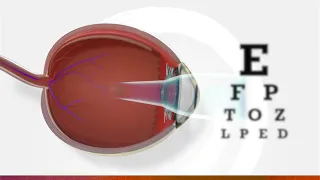 What is myopia? | 3D animation of myopia