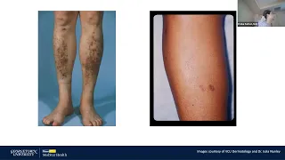 Dermatologic Manifestations of Diabetes Mellitus