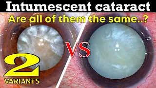 Intumescent Cataracts .Are all of them the same..?  - Dr Deepak Megur