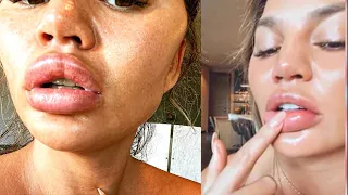 Chrissy Tiegen’s Lips Had Allergic Reaction, Not Filler