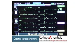 Le coeur: L'électrocardiogramme (ECG)