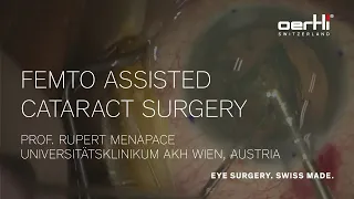 Showcase: Femto assisted cataract surgery by Rupert Menapace