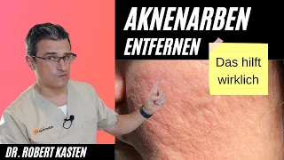 AKNENARBEN schnell entfernen, so wird man Sie wirklich los |  Dr. Kasten Hautmedizin in Mainz