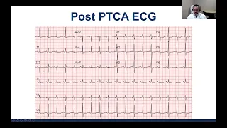 CICU: Post PTCA ECG Interpretation - JACC PCP | Cardiac Arrest After Stem Cell Transplant