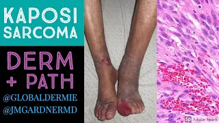 Kaposi Sarcoma: Dermatology/Pathology Collaboration by @globaldermie & @JMGardnerMD