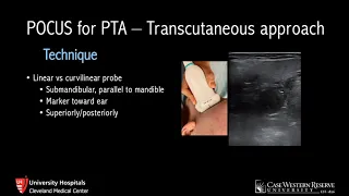 Ultrasound for Peritonsillar Abscess