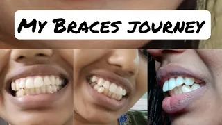 My Braces journey / four Tooth Extraction