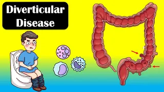 Diverticular Disease And Diverticulitis - Causes, Signs & Symptoms, Diagnosis, Treatment