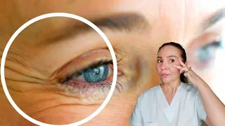 How to reduce under eye wrinkles | Wrinkles around the eyes (Crow'sfeet)