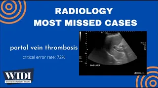 Most Missed Cases: Portal Vein Thrombosis