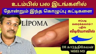 கொழுப்பு கட்டிகளுக்கு என்ன மருத்துவம்? | Lipoma Treatment Home Remedies Tips Doctor Karthikeyan