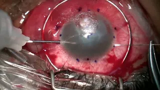 Basket Suture to Prevent Lens Expulsion During Penetrating Keratoplasty
