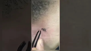 ingrown hair removal 😌 (ENJOY)