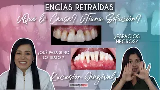 Encías Retraídas, Causas y Soluciones #RecesiónGingival 🦷 - Odontología Láser.