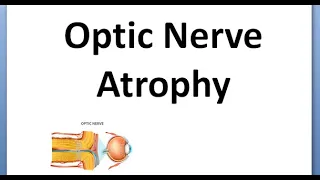 Ophthalmology 334 Optic Atrophy Primary Secondary Consecutive Marcus Gunn Pupil RAPD drusen