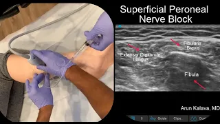 Superficial Peroneal Nerve Block- Ultrasound Guided
